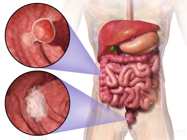 Cancer du côlon ou cancer colorectal : symptômes, causes, traitement