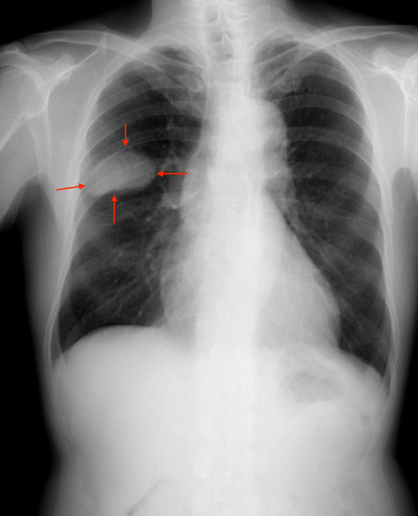 Cancer bronchique