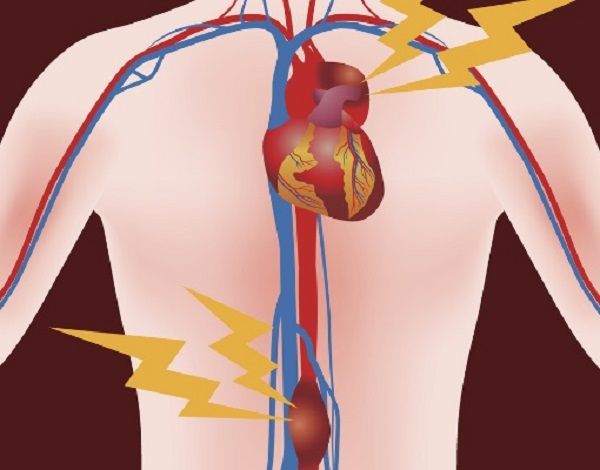 Anévrisme de l'aorte abdominale sous rénale