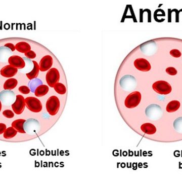 Anémies : Définition, symptômes, causes et traitement