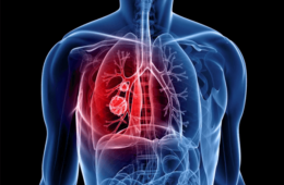 Cancer broncho-pulmonaire professionnel
