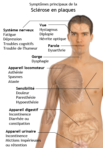 Sclérose en plaques