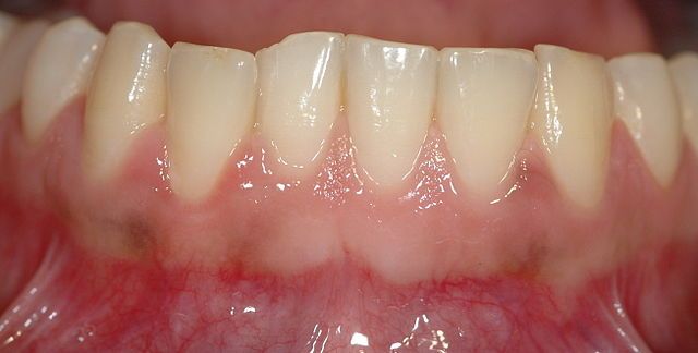 Formes particulières de parodontopathies