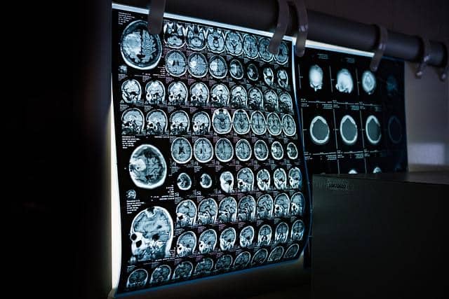 Maladies neurologiques